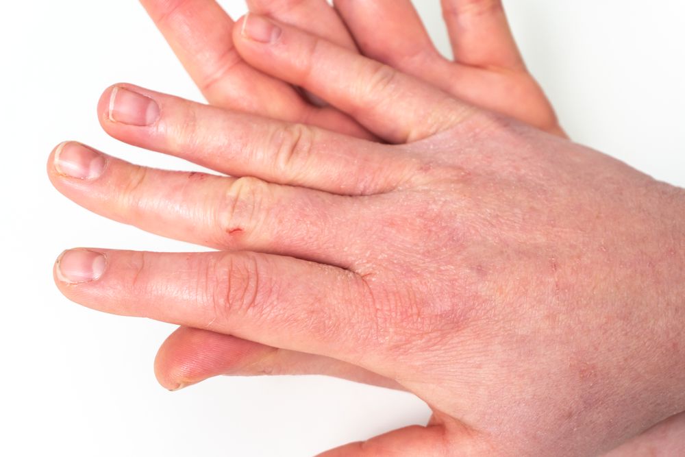 Huiduitslag en koorts bij volwassenen: Oorzaken, Symptomen & Behandeling