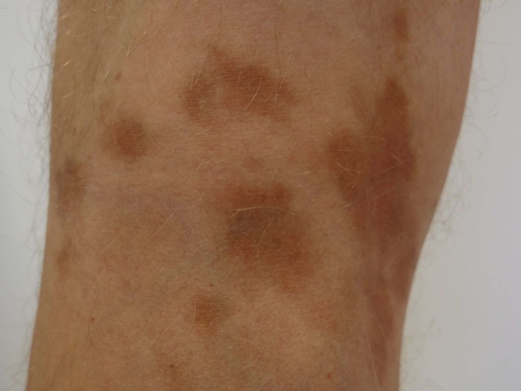 Huidziekte bruine vlekken: Oorzaken, symptomen en behandelingen